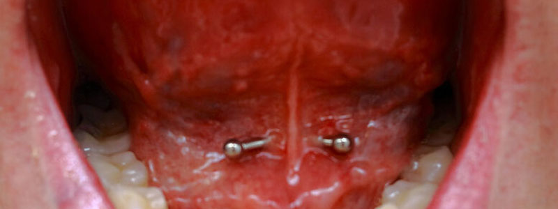 piercing frenillo lengua