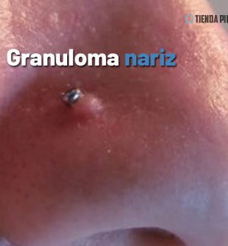 granuloma-nariz