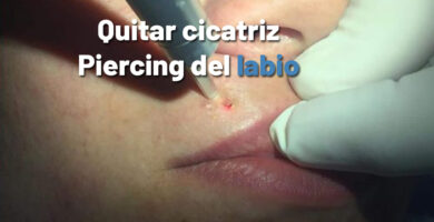 quitar cicatriz piercing labio